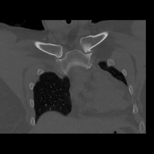 Condensing Osteitis CT